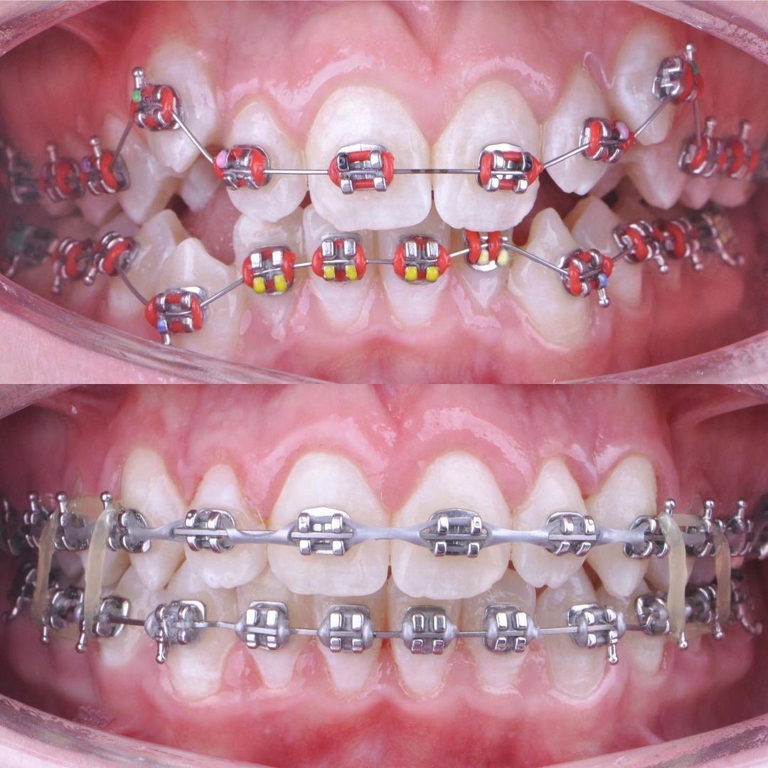 Braces and Aligners